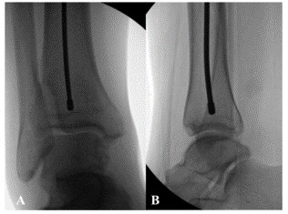 Tibial Intramedullary Nail Fixation Technique-10 Tècnica de fixació de l'ungla intramedul·lar tibial-10