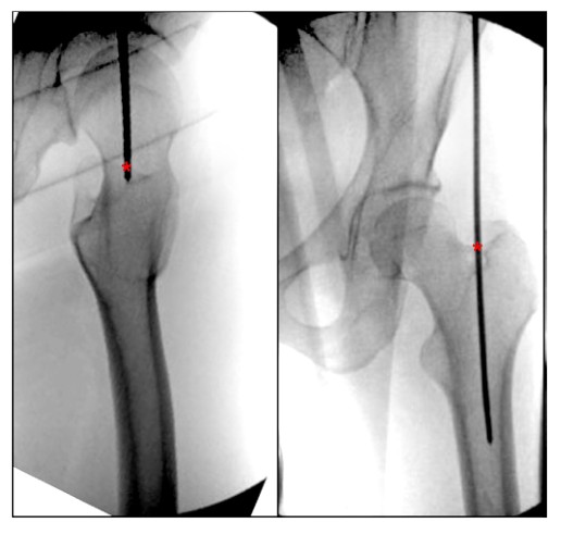 Femoral Intramedullary Nailing - How To Choose The Best Insertion Point-4 Femoral Intramedullary Nailing - Paano Pumili Ang Pinakamahusay na Insertion Point-4