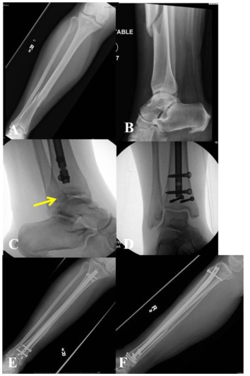 Tibial Intramedullary Nail Fixation Technique-1 Tècnica de fixació de l'ungla intramedul·lar tibial-1