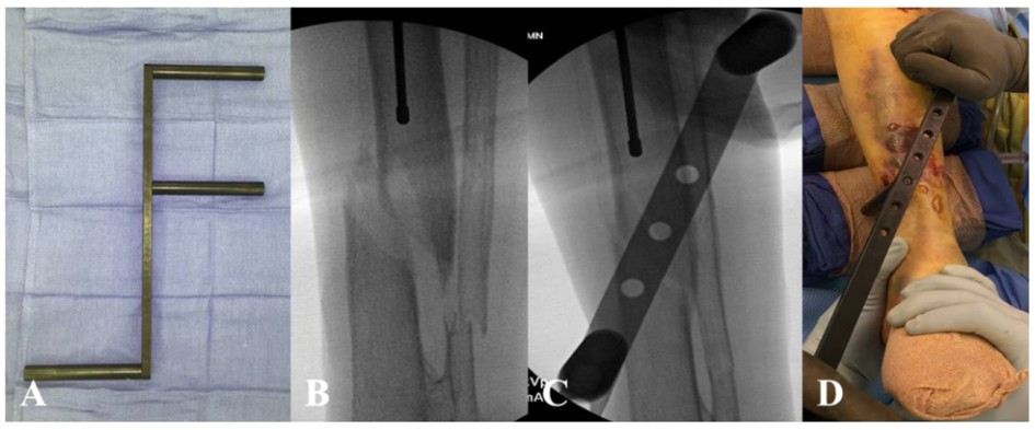 Tibial Intramedullary Nail Fixation Technique-5 Tècnica de fixació de l'ungla intramedul·lar tibial-5