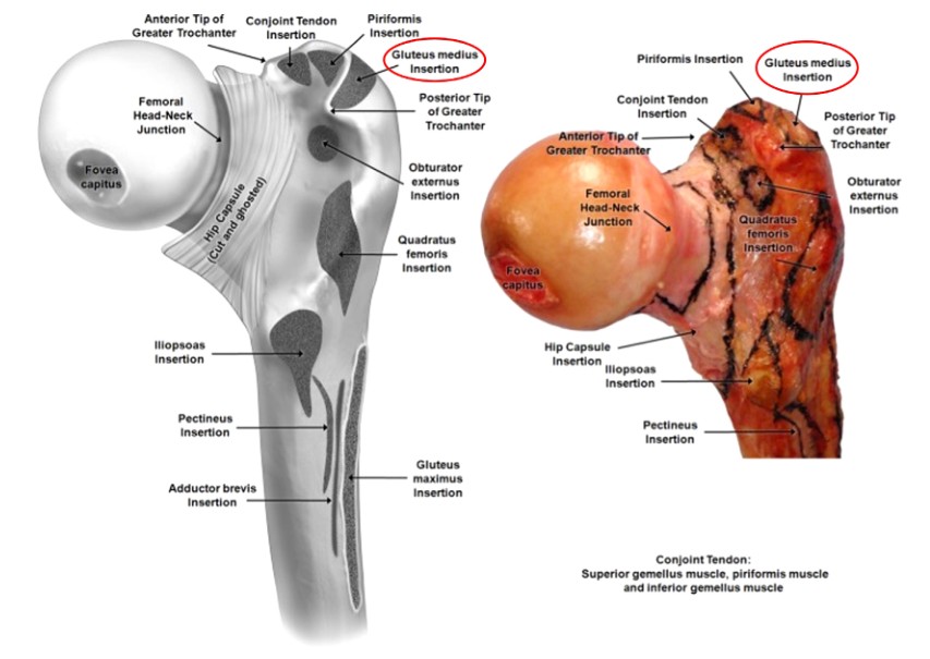 Femoral Intramedullary Nailing - How To Choose The Best Insertion Point-2 Femoral Intramedullary Nailing - Paano Pumili Ang Pinakamahusay na Insertion Point-2