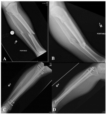 Tibial Intramedullary Nail Fixation Technique-12 Tècnica de fixació de l'ungla intramedul·lar tibial-12