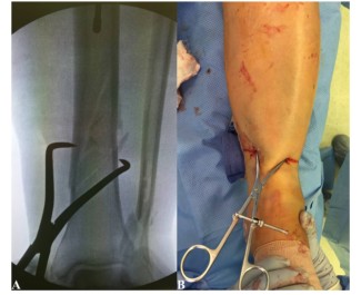 Tibial Intramedullary Nail Fixation Technique-7 Tècnica de fixació de l'ungla intramedul·lar tibial-7