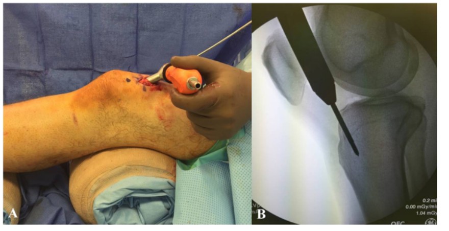 Tibial Intramedullary Nail Fixation Technique-3 Tècnica de fixació de l'ungla intramedul·lar tibial-3