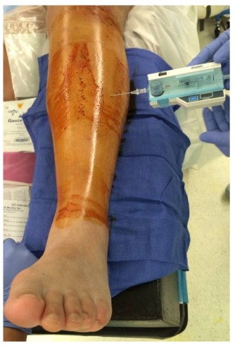 Tibial Intramedullary Nail Fixation Technique Tècnica de fixació de l'ungla intramedul·lar tibial