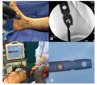 Tibial Intramedullary Nail Fixation Technique-11 Tècnica de fixació de l'ungla intramedul·lar tibial-11