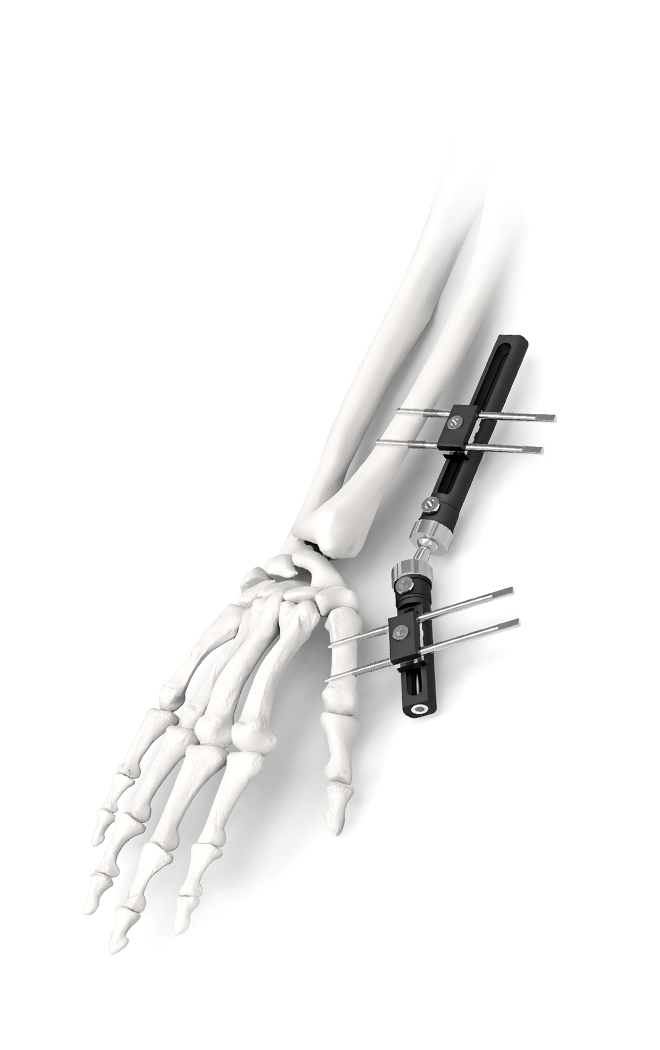 Тышкы фиксаторлор системасы