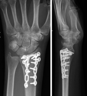 Zlomi distalnega radiusa-13