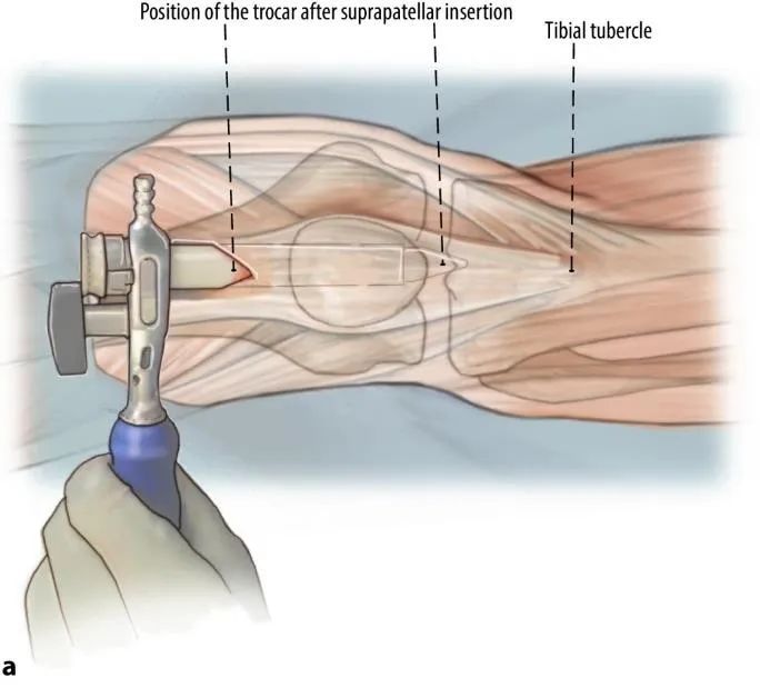 Fraktur tibial, t&eacute;hnik kuku intramedullary suprapatellar-7