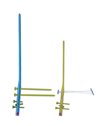 Intramedulláris köröm