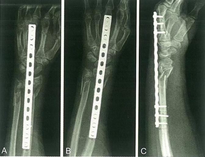 Zlomi distalnega radiusa-21