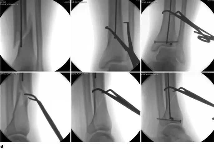 fraktur tibial, suprapatellar intramedullary t&eacute;hnik kuku-14