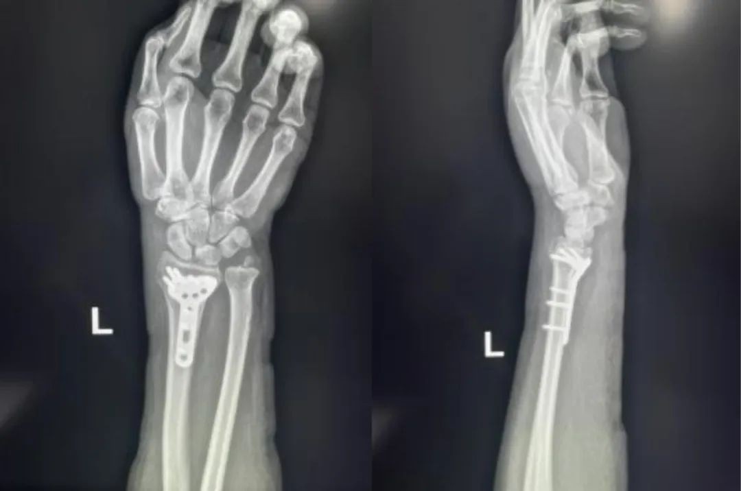 Zlomi distalnega radiusa-18