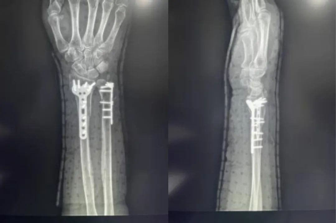 Zlomi distalnega radiusa-16