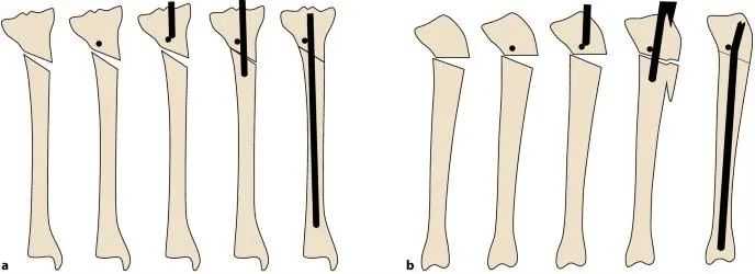 fractures tibial, suprapatellar intramedullary t&eacute;hnik kuku-20