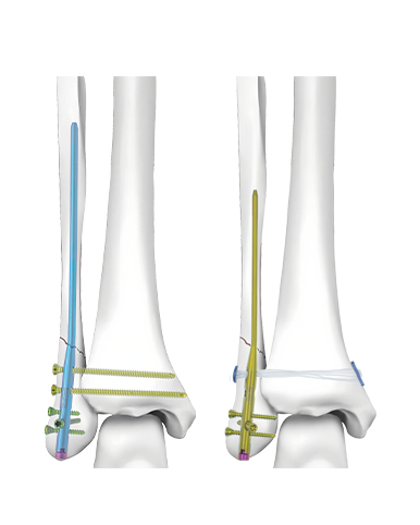 Intramedulláris köröm