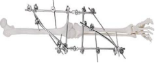 Knee joint Combinational fixator