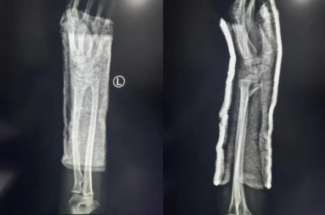 Zlomi distalnega radiusa-17