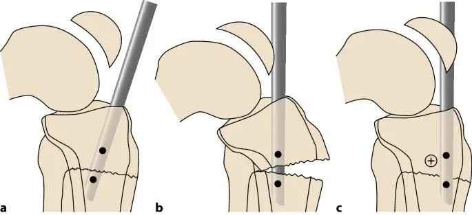 Fraktur tibial, t&eacute;hnik kuku intramedullary suprapatellar