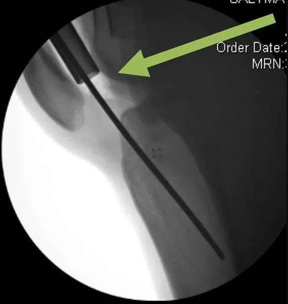 fractures tibial, suprapatellar intramedullary t&eacute;hnik kuku-22