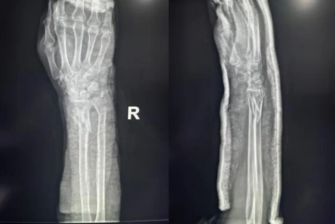 Zlomi distalnega radiusa-15