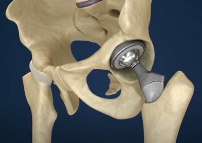 Orthopaedic-hip