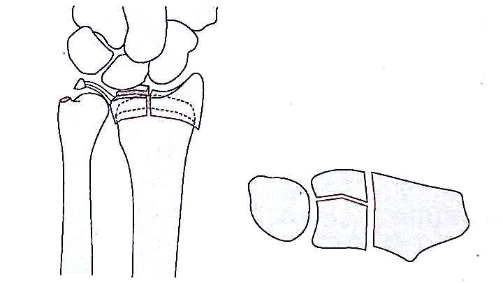 Zlomi distalnega radiusa-5