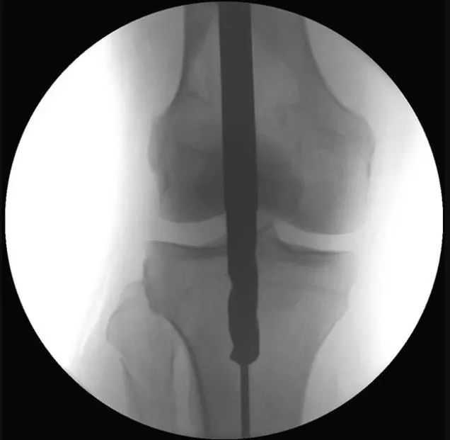 fraktur tibial, suprapatellar intramedullary t&eacute;hnik kuku-13