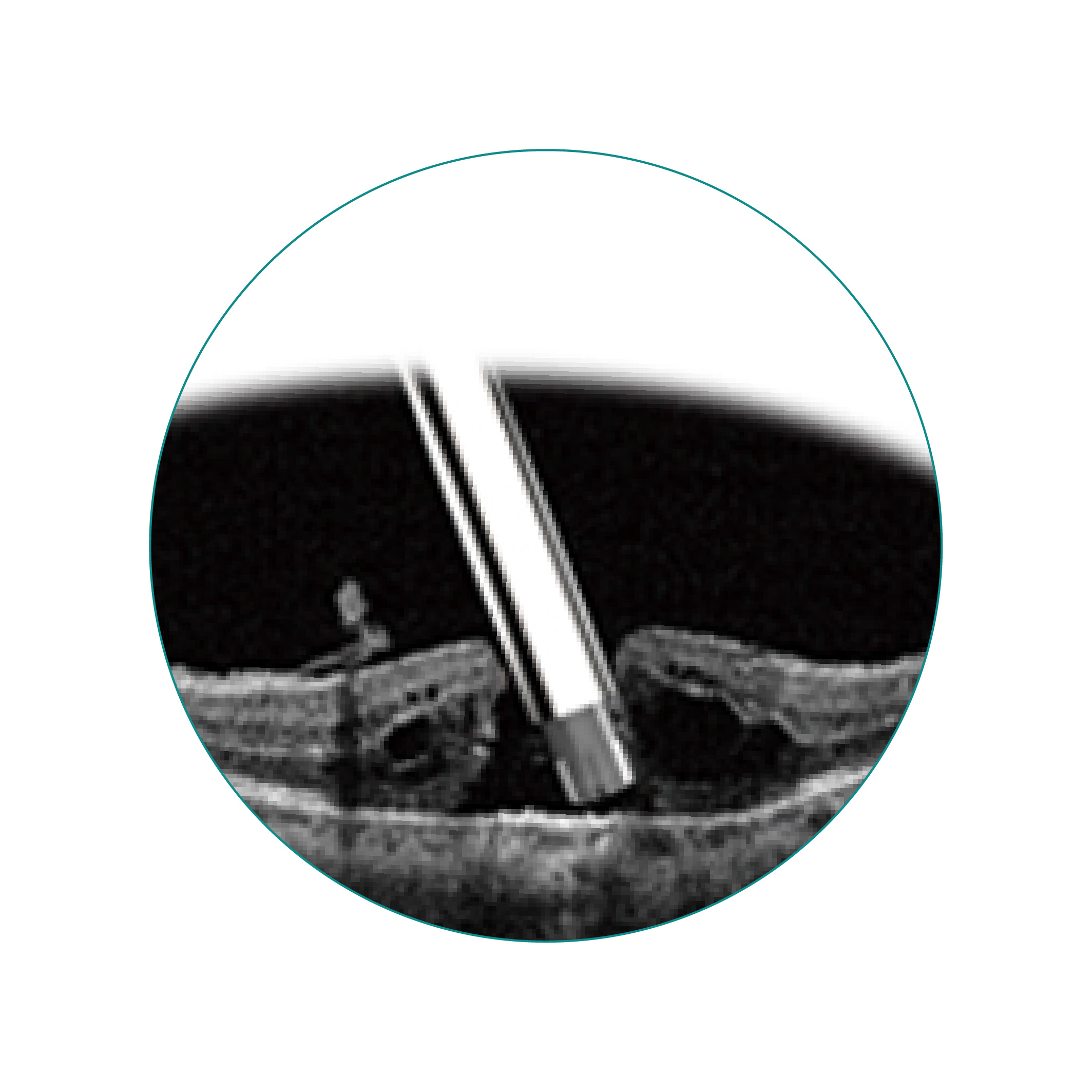 UN-5012（23G）笛针