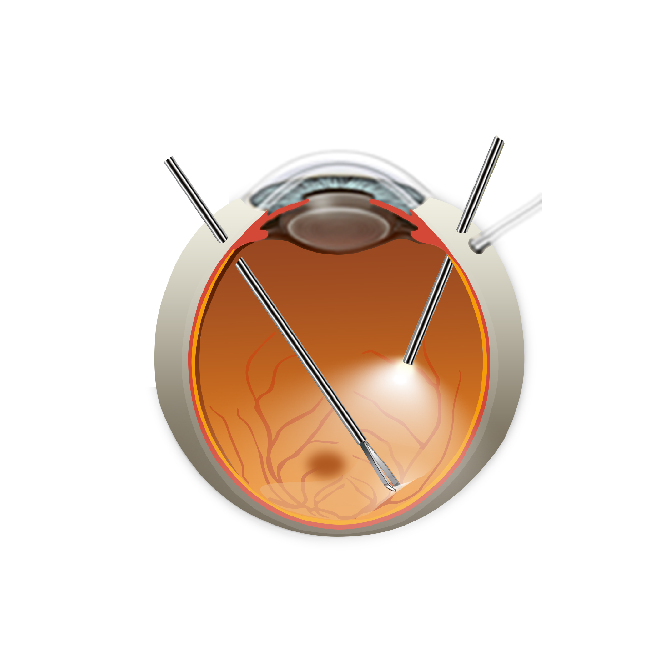 UN-3702（23G）眼底非对称性视网膜镊