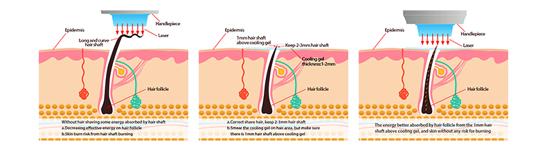 Diode Laser Hair Removal