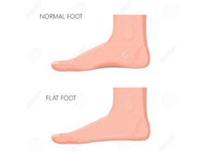 The Basic Understanding of Flat Feet You Should Know