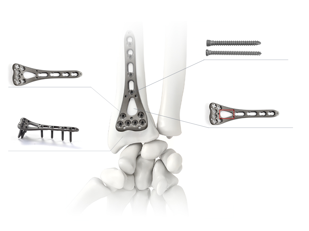 Distal Radius Plate Systemin anatomiset suunnittelutiedot